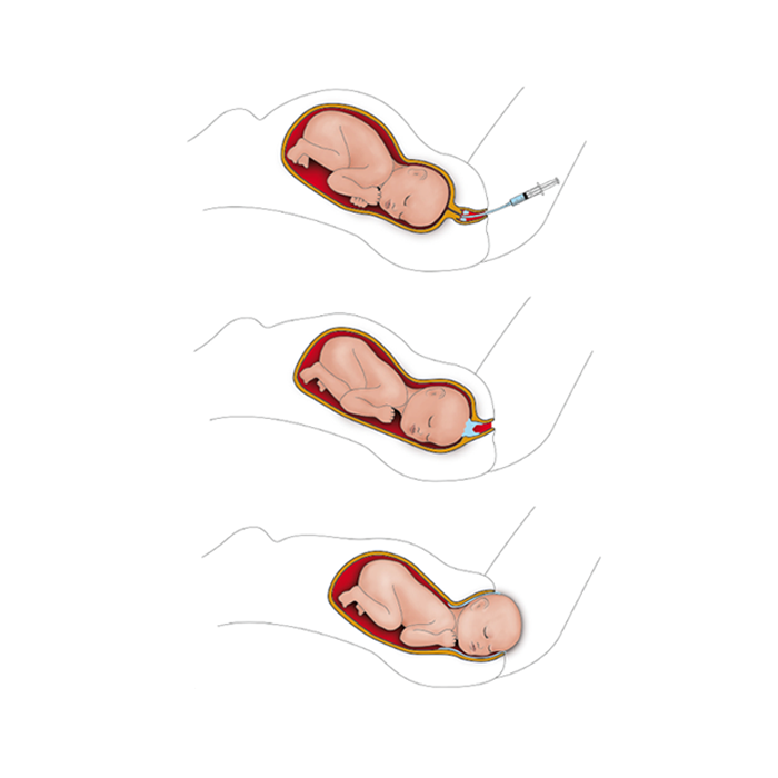 Ardo_Natal_Support_Geburtsgel_Anwendung