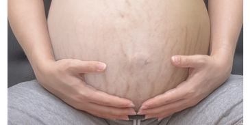 Babybauch_Tigerstripes.png